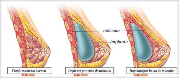 cirurgia mamaria de protese de silicone